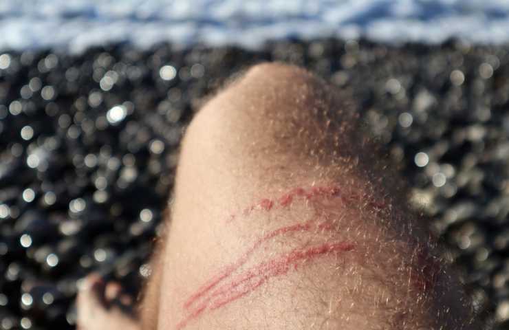 cicatrice per puntura di medusa