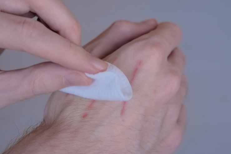 disinfettare ferita sulla mano